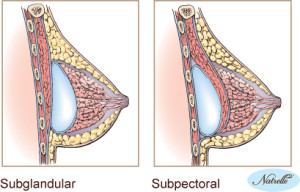 Breast Implant Position Breast Surgeon San Diego