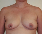 Feel Beautiful - Breast Augmentation Case 5 - Before Photo