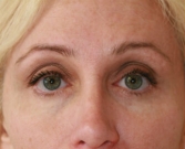 Feel Beautiful - Eyelid Surgery San Diego Case 45 - Before Photo