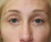 Feel Beautiful - Eyelid Surgery San Diego Case 45 - After Photo