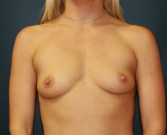 Feel Beautiful - Breast Augmentation Case 4 - Before Photo