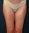 Feel Beautiful - Thigh Gap Surgery (liposuction) - Before Photo