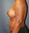 Feel Beautiful - Breast Lift San Diego 23 - After Photo