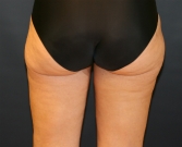 Feel Beautiful - Liposuction Inner and Outer Thighs - After Photo