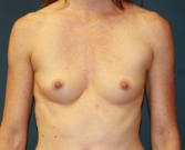 Feel Beautiful - High (Full) Profile Breast Augmentation - Before Photo