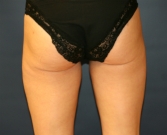 Feel Beautiful - Liposuction Thinner Thighs - After Photo