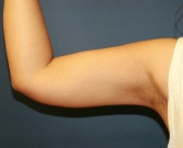 Feel Beautiful - Liposuction Arms (right) - After Photo