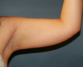Feel Beautiful - Liposuction Left Arm - Before Photo