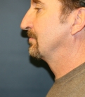 Feel Beautiful - Chin Implant with Neck procedure - After Photo