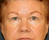 Feel Beautiful - Upper Eyelid Skin Removal - Before Photo