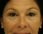 Feel Beautiful - Lower eyelid tightening surgery - Before Photo