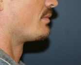 Feel Beautiful - Chin Implant for Men - After Photo