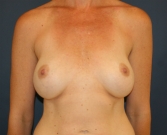 Feel Beautiful - Revision to Lift and Centralize Implants - Before Photo