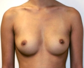 Feel Beautiful - Breast Augmentation Case 10 - Before Photo