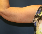 Feel Beautiful - Left Arm Lift San Diego after weight loss - After Photo