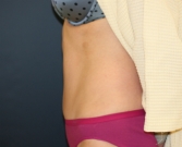 Feel Beautiful - Tummy Tuck after three boys - After Photo