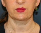 Feel Beautiful - Lipo Lower Face, Neck, & Chin Implant - Before Photo