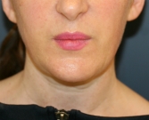 Feel Beautiful - Lipo Lower Face, Neck, & Chin Implant - After Photo
