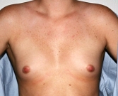 Feel Beautiful - Breast Augmentation Case 17 - Before Photo