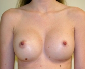 Feel Beautiful - Breast Augmentation Case 18 - After Photo
