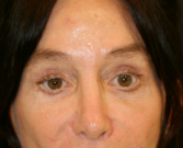 Feel Beautiful - Revision Eyelid Surgery - Before Photo
