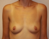 Feel Beautiful - Breast Augmentation Case 26 - Before Photo