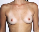 Feel Beautiful - Breast Augmentation Case 35 - Before Photo