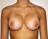 Feel Beautiful - Breast Augmentation Case 38 - After Photo