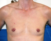 Feel Beautiful - Breast Augmentation Case 40 - Before Photo