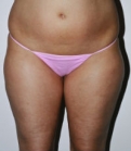 Feel Beautiful - Liposuction Case 2 - Before Photo