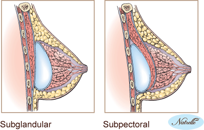 Subglandular Vs Submuscular Breast Implants