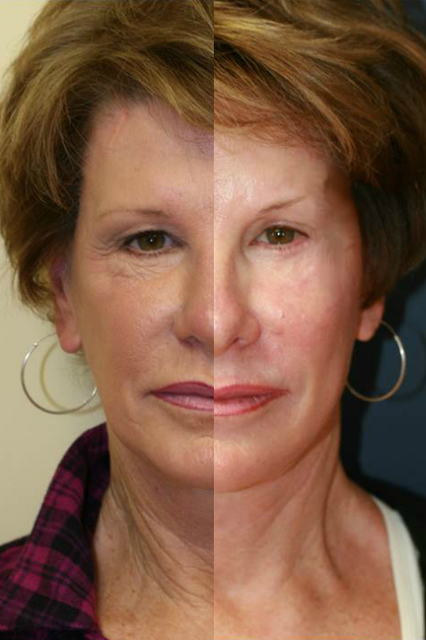 split facelift face-lift results for feelbeautiful