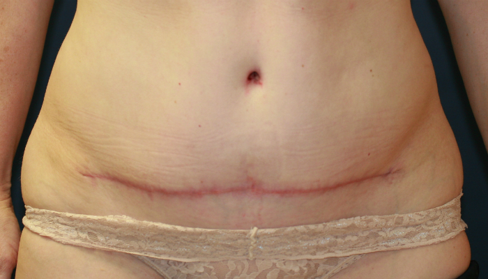 What Kind of Scar Can I Expect After a Tummy Tuck? - Power Plastic