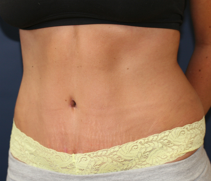 Does A Tummy Tuck Leave A Scar?