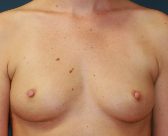 After nipple eversion procedure, Dr. Steve Laverson
