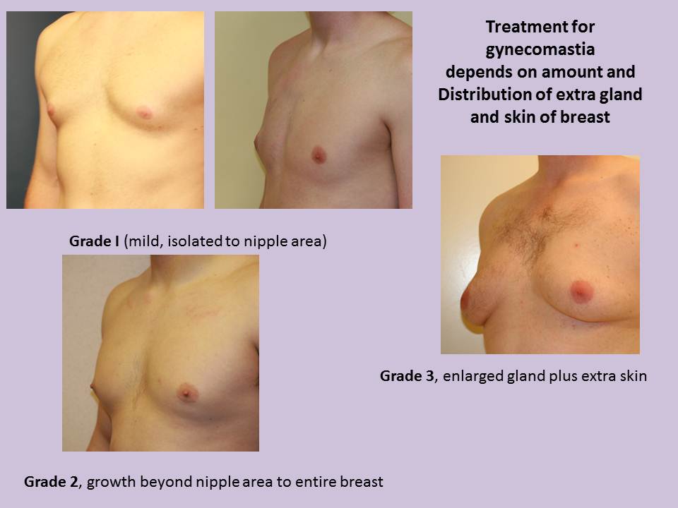 man-boobs-male-breast-reduction-gynecomastia-San-Diego-Plastic-Surgery