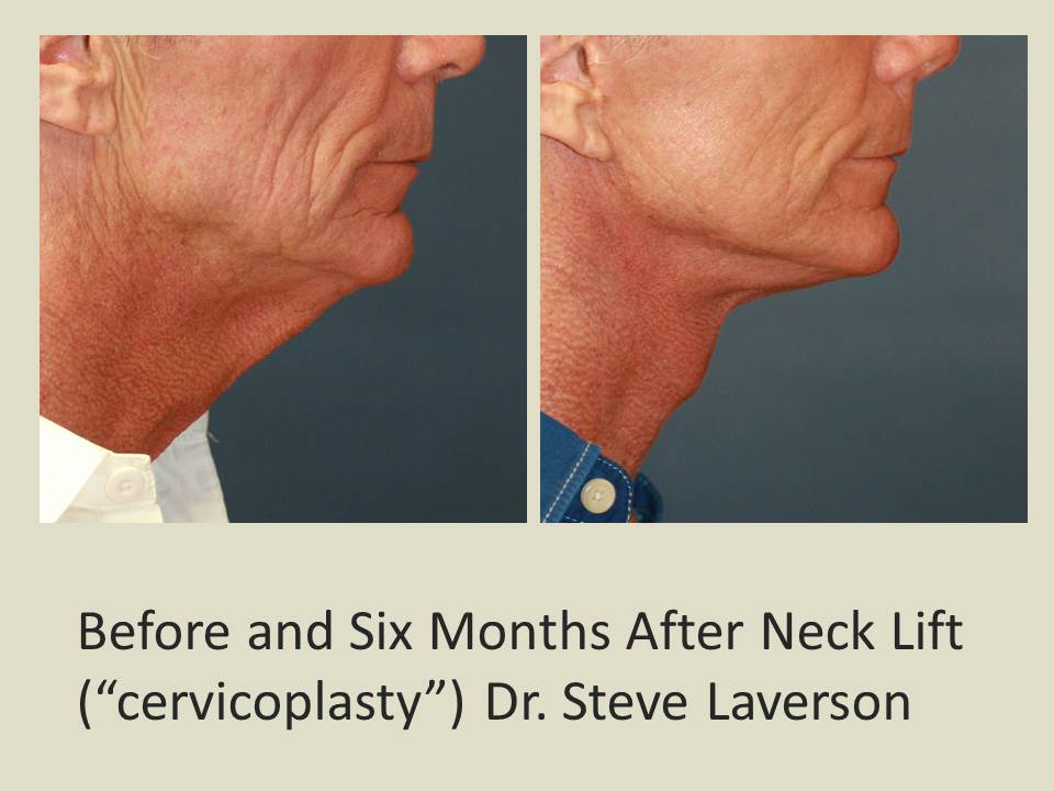 neck-lift-necklift-san-diego-feel-beautiful-plastic-surgery
