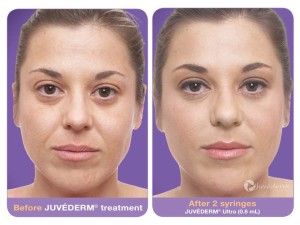 Wrinkle Filler Doctor San Diego Plastic Surgeon