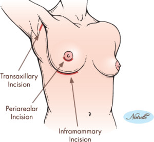 breast implant breast augmentation scars San Diego