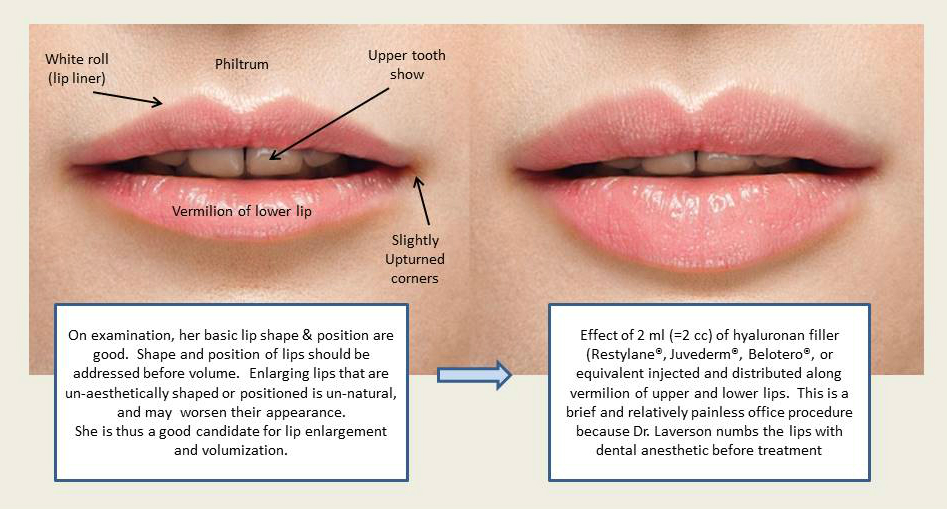 Type Of Lip Fillers | Your Complete Guide to Juvéderm® & Restylane®