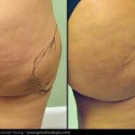 liposuction marking