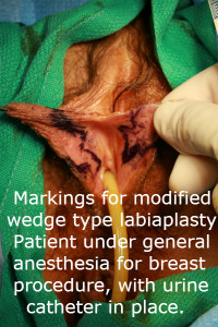 Labiaplasty Labia Reduction San Diego Markings