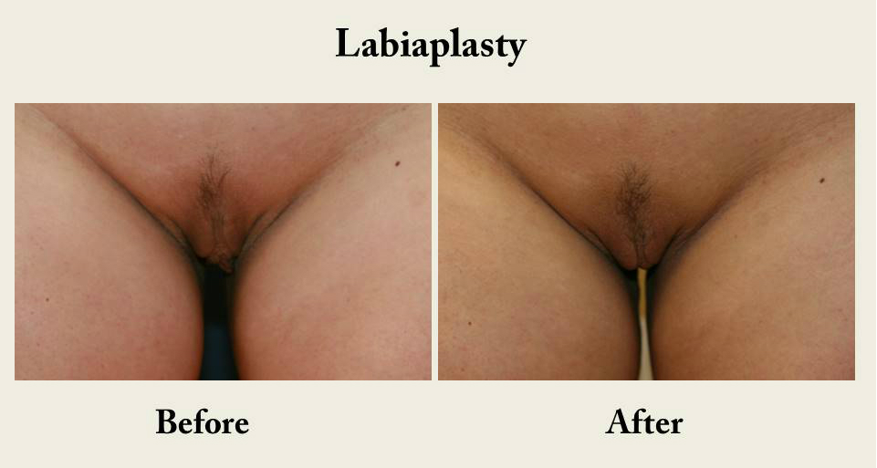 Labiaplasty-labia-reduction-vagina-cosmetic-surgery-san-diego-1
