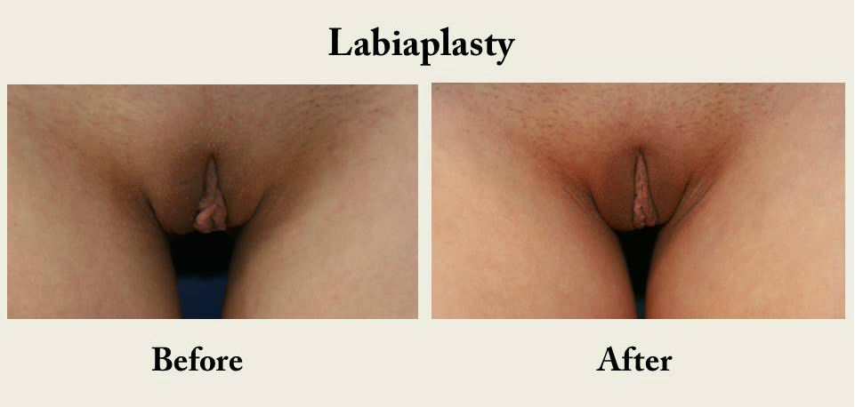 Labiaplasty-labia-reduction-vagina-cosmetic-surgery-san-diego-2
