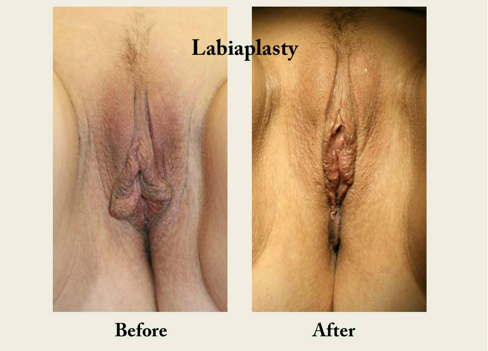 Labiaplasty-labia-reduction-vagina-cosmetic-surgery-san-diego-3