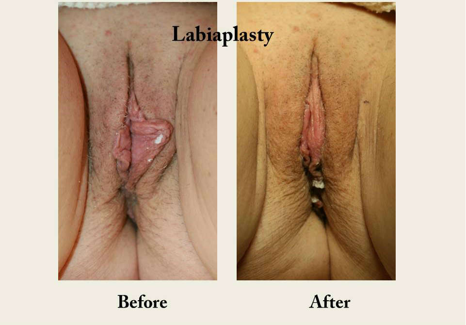 Labiaplasty-labia-reduction-vagina-cosmetic-surgery-san-diego-5