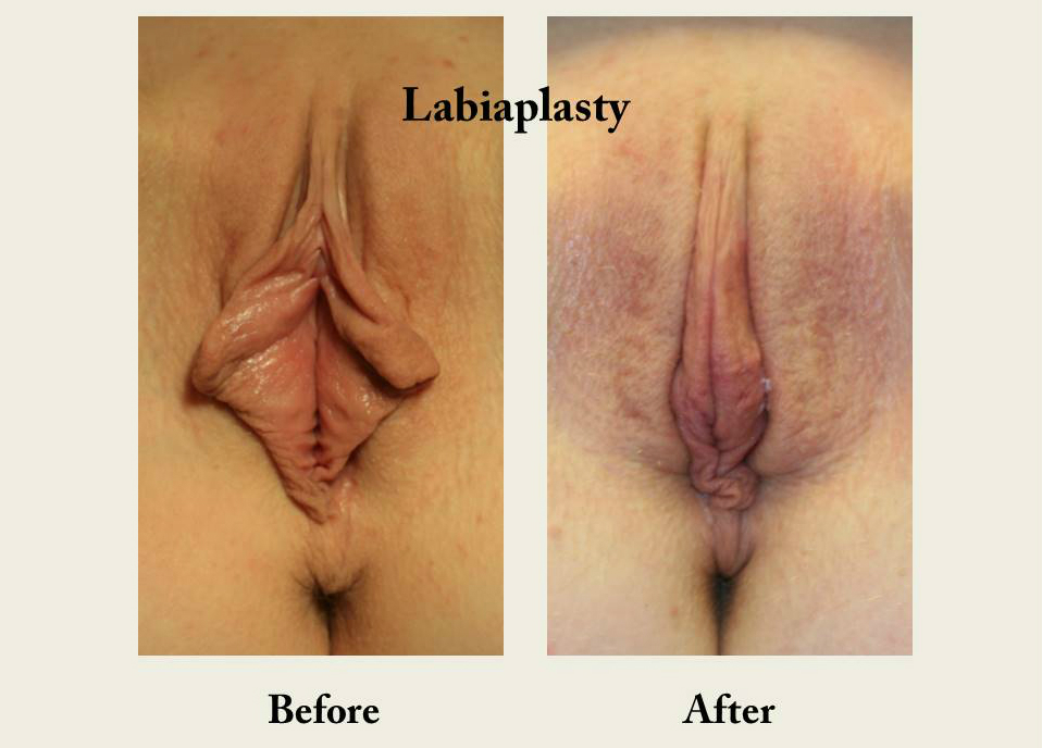Labiaplasty-labia-reduction-vagina-cosmetic-surgery-san-diego-6