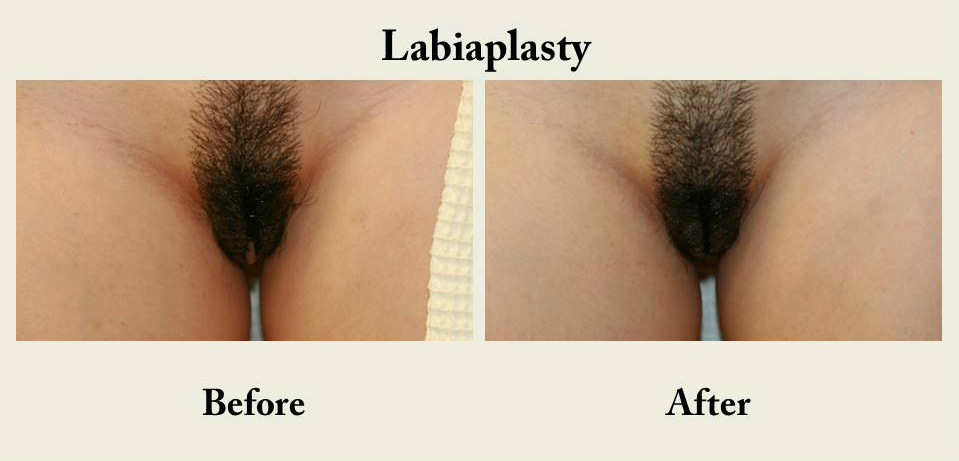 Labiaplasty-labia-reduction-vagina-cosmetic-surgery-san-diego-7