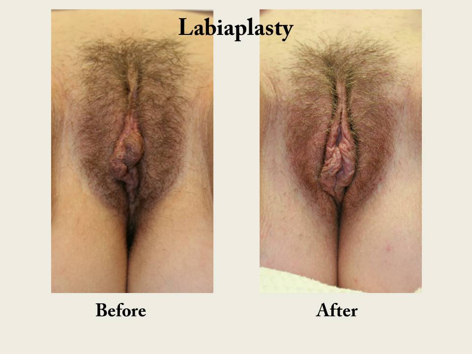 Labiaplasty-labia-reduction-vagina-cosmetic-surgery-san-diego-8