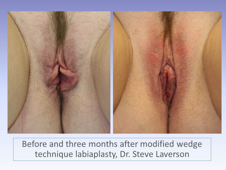 labiaplasty San Diego Dr. Laverson